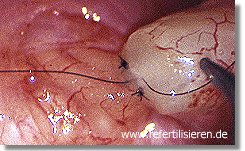 Vasektomie bluterguss nach gma.cellairis.com: Sterilisation